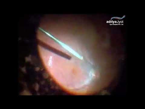Surgery For Pellet Eye Injury In Conflict Torn Kashmir – vitrectomy