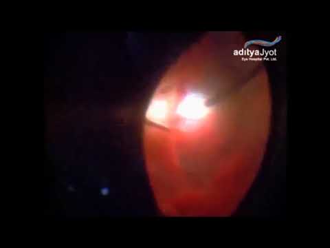 Surgery For Pellet Eye Injury In Conflict Torn Kashmir – pellet removal