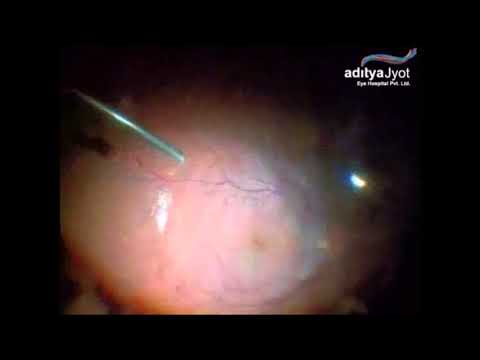 Surgery For Pellet Eye Injury In Conflict Torn Kashmir – retinal detachment