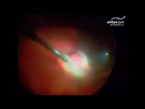 Surgery For Pellet Eye Injury In Conflict Torn Kashmir – foreign body pellet